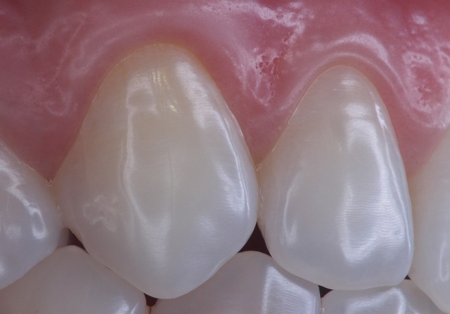 Gum Disease: Causes, Symptoms, and Prevention