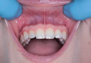 What Is Gum Disease?