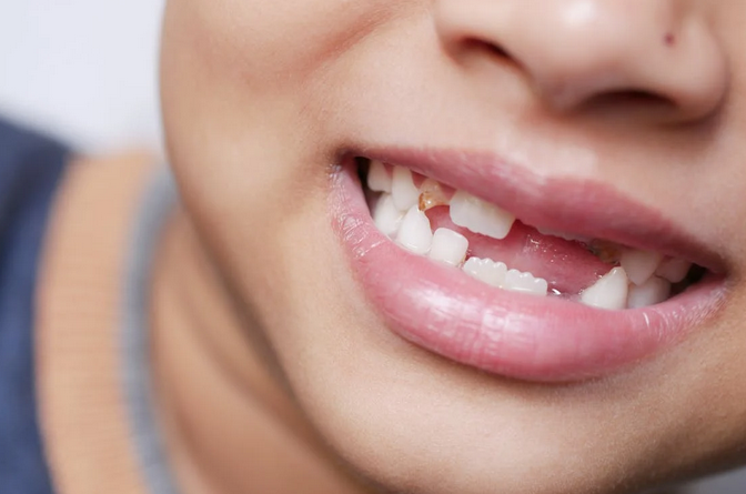 missing teeth